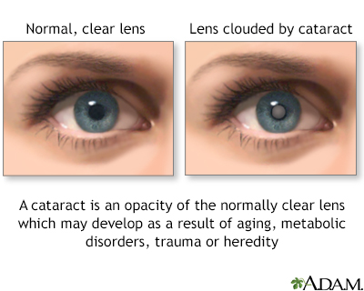 Cataracts