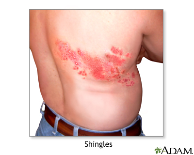 Shingles And Chickenpox Varicella Zoster Virus
